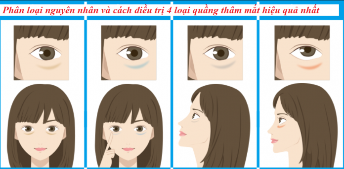 Phân loại và cách điều trị 4 loại quầng thâm mắt