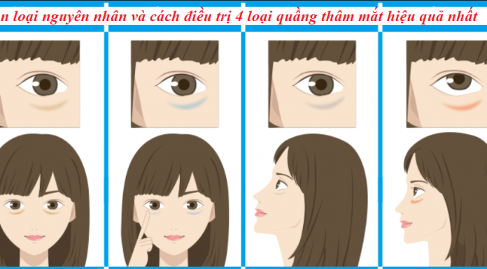 Phân loại và cách điều trị 4 loại quầng thâm mắt